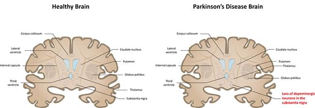 cannabis parkinson's