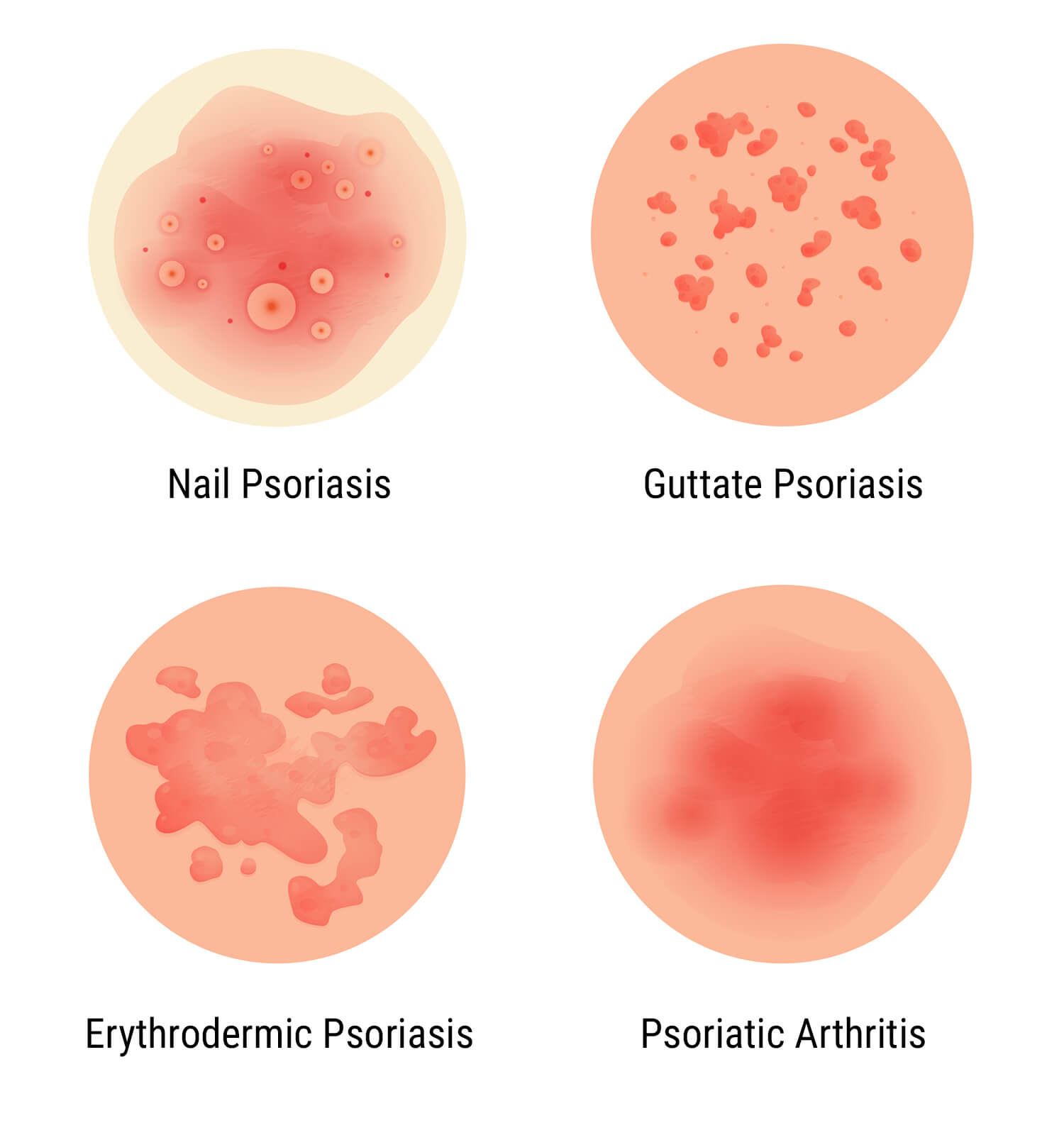 What Is Psoriasis?