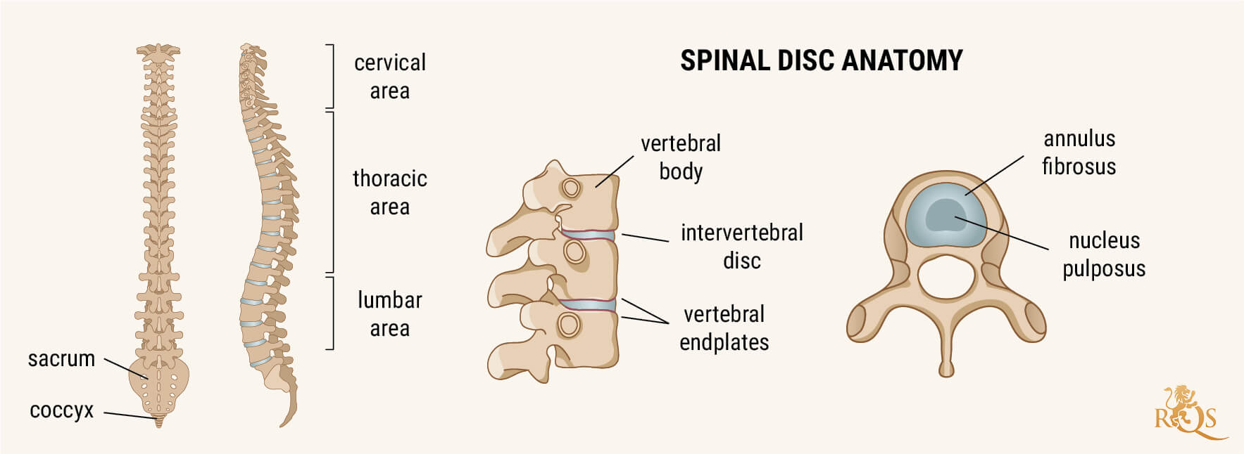 What Is Degenerative Disc Disease?