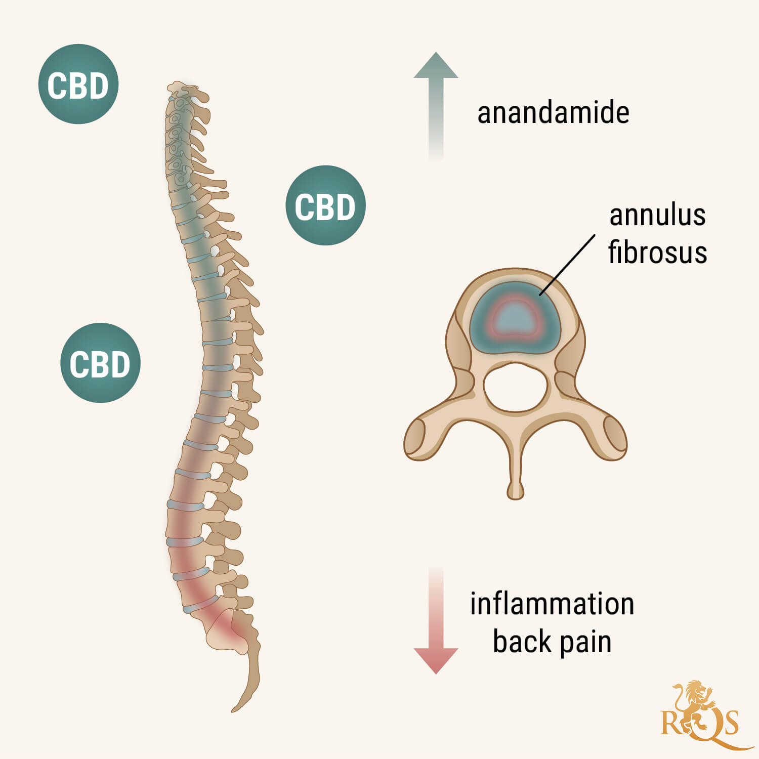 How Does CBD Help Degenerative Disc Disease?