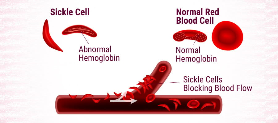 Sickle Cell Anaemia: Can Cannabis Help The Condition ...