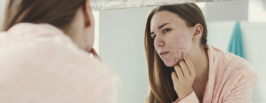 How Acne Forms