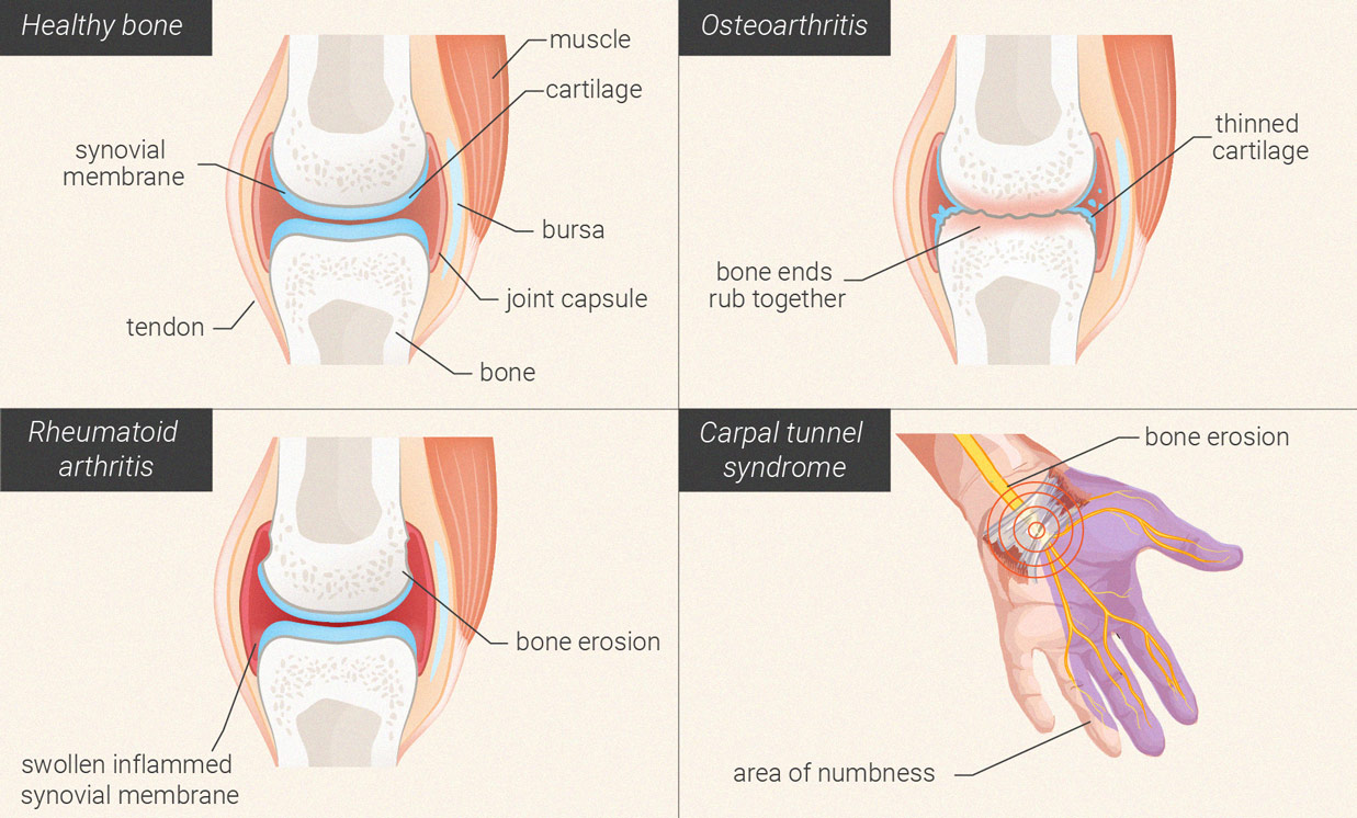 Are arthritis and rheumatism the same?