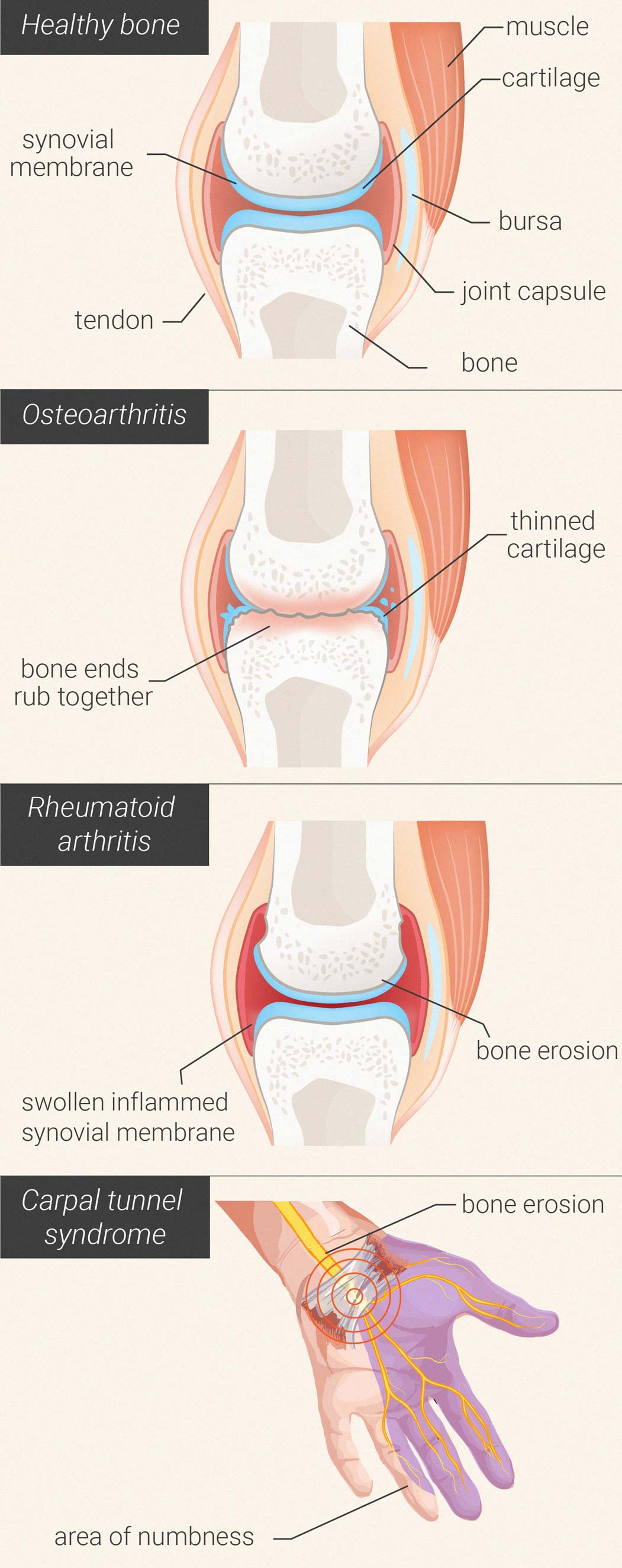 Are arthritis and rheumatism the same?