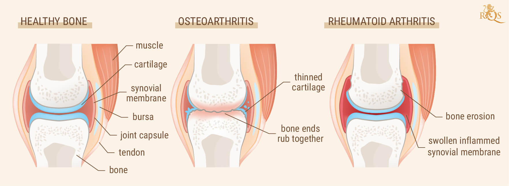 Are arthritis and rheumatism the same?