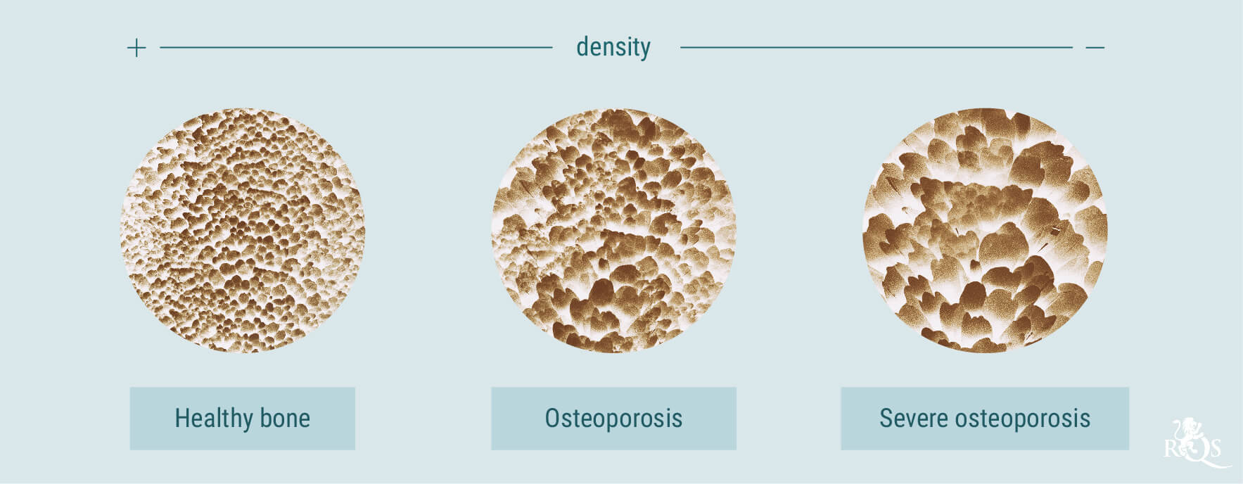 Cannabis and Osteoporosis