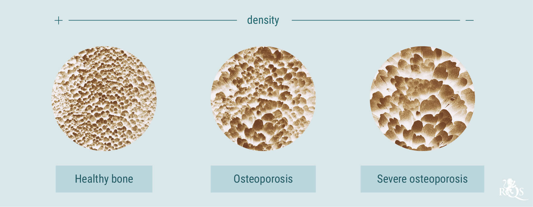Cannabis and Osteoporosis Cannabis and Osteoporosis