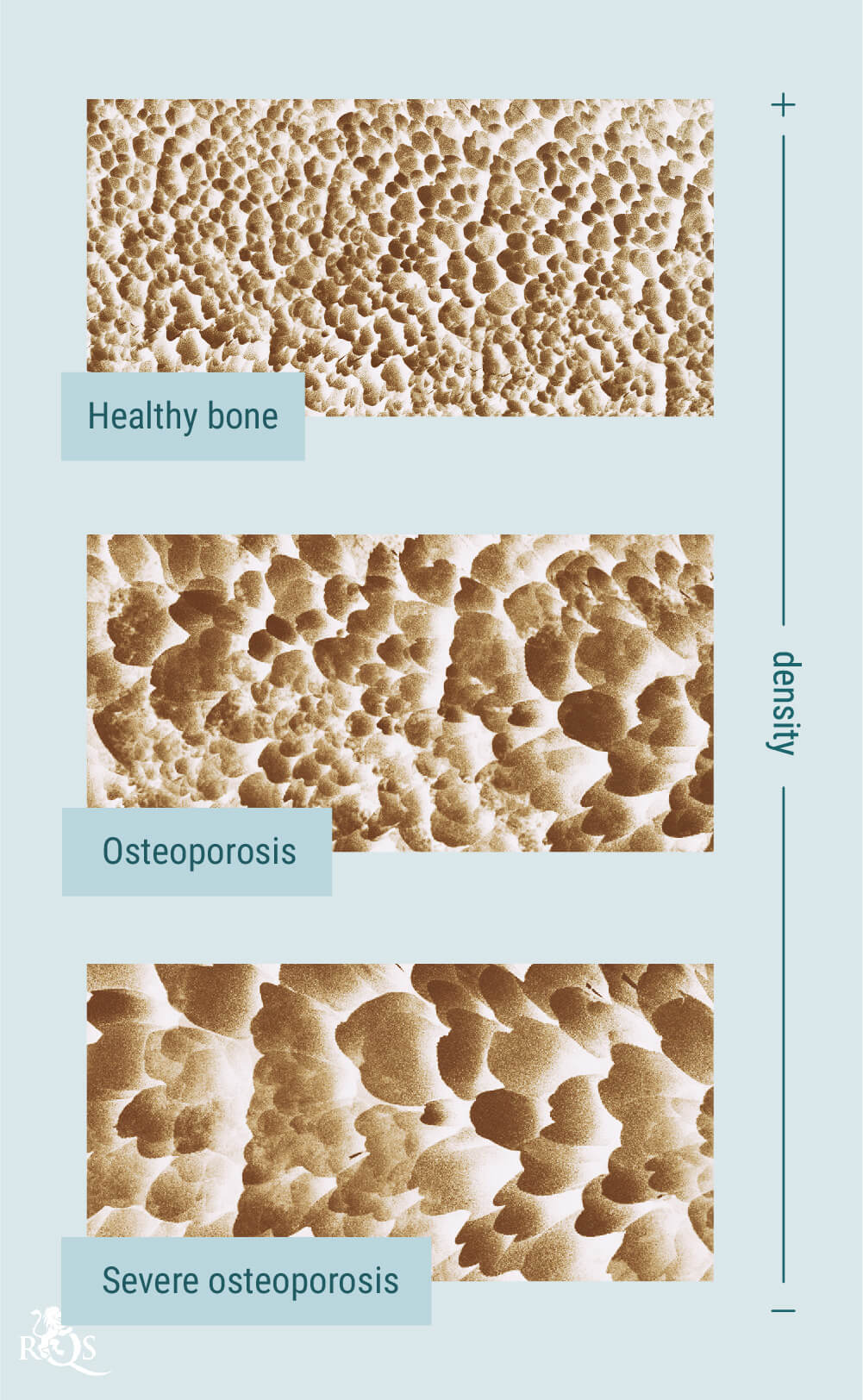 Cannabis and Osteoporosis