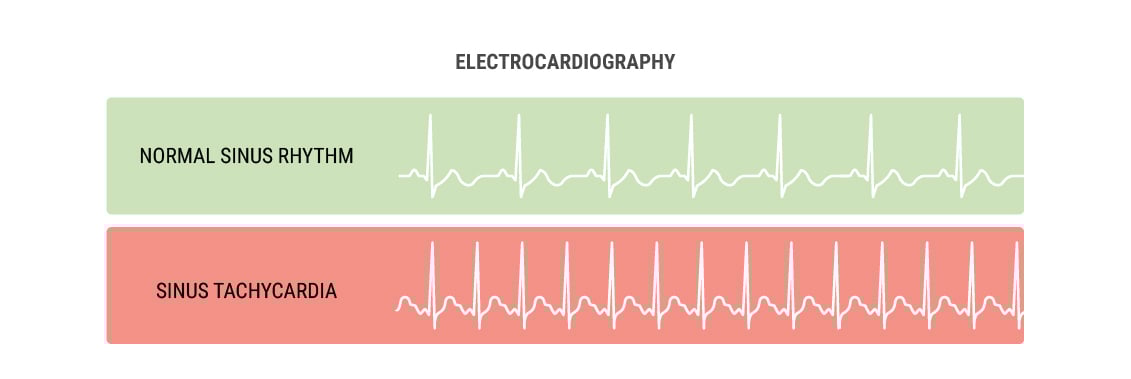 Why Does Cannabis Cause the Heart To Race? Why Does Cannabis Cause the Heart To Race?