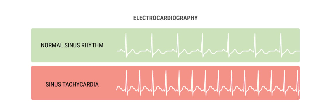 Why Does Cannabis Cause the Heart To Race?