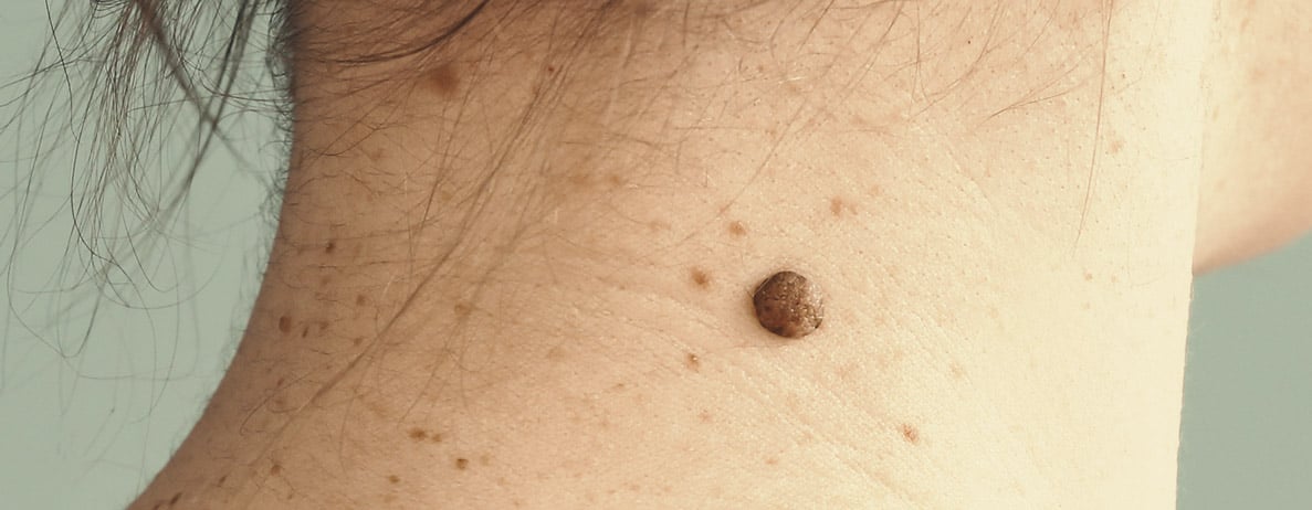 Symptoms of Melanoma