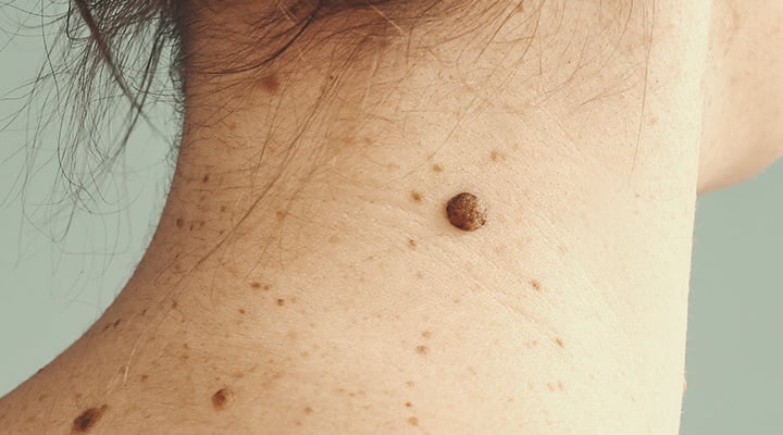 Symptoms of Melanoma