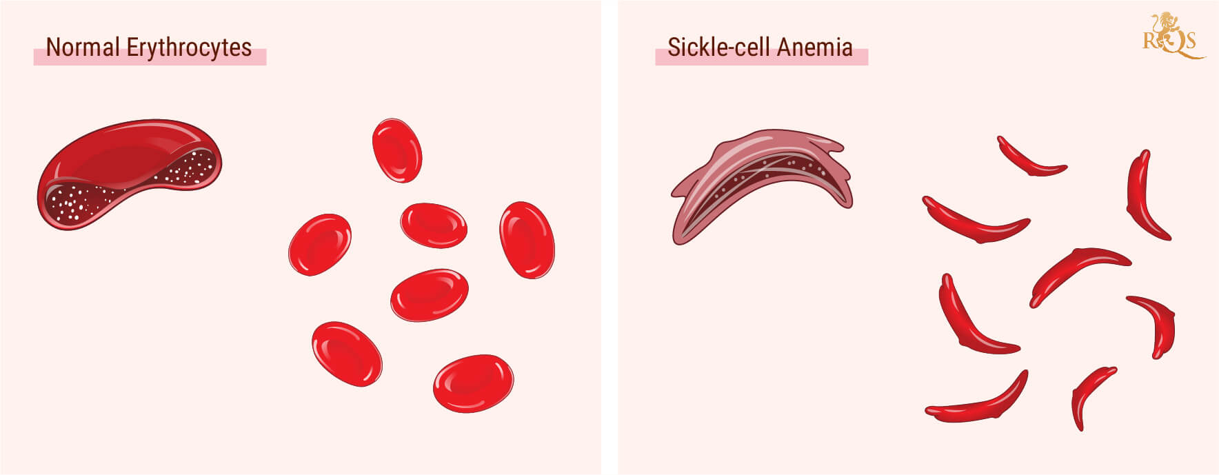 What Is Sickle Cell Anemia? What Is Sickle Cell Anemia?