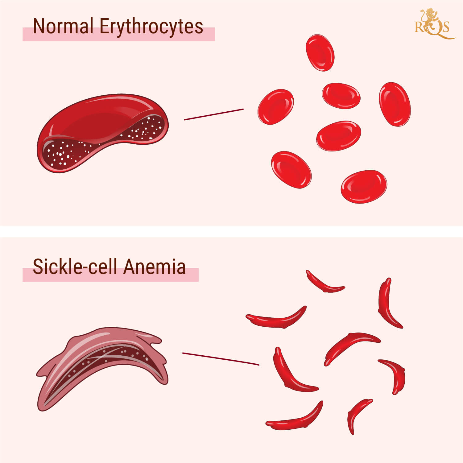 What Is Sickle Cell Anemia? What Is Sickle Cell Anemia?