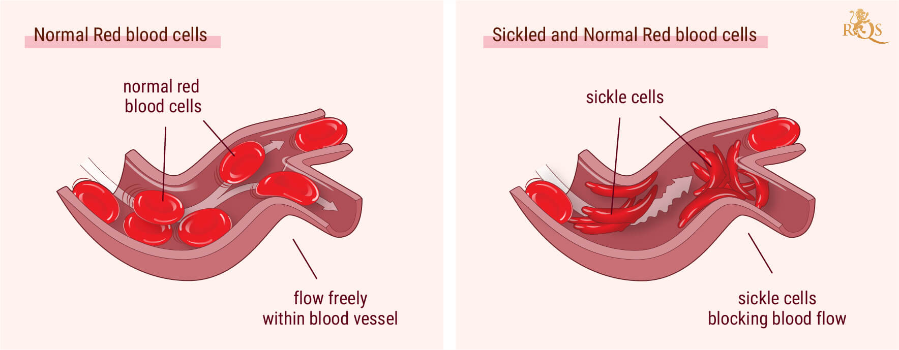 Cannabis and Sickle Cell Anemia Symptoms Cannabis and Sickle Cell Anemia Symptoms
