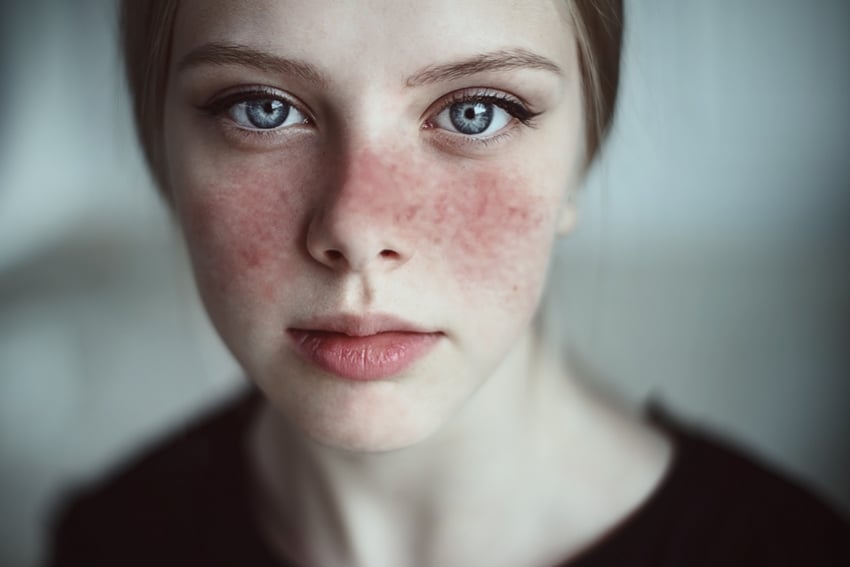 Detalle de mujer joven con manifestaciones de lupus en el rostro