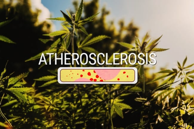 Can Cannabis Effectively Treat Atherosclerosis?
