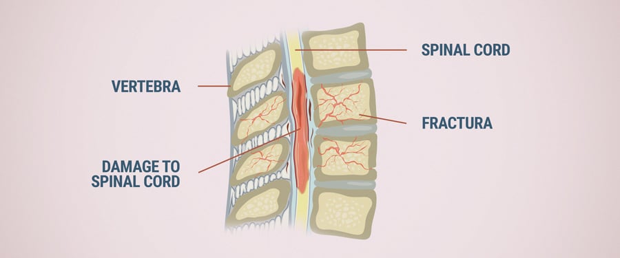 Damage To Spinal Cord