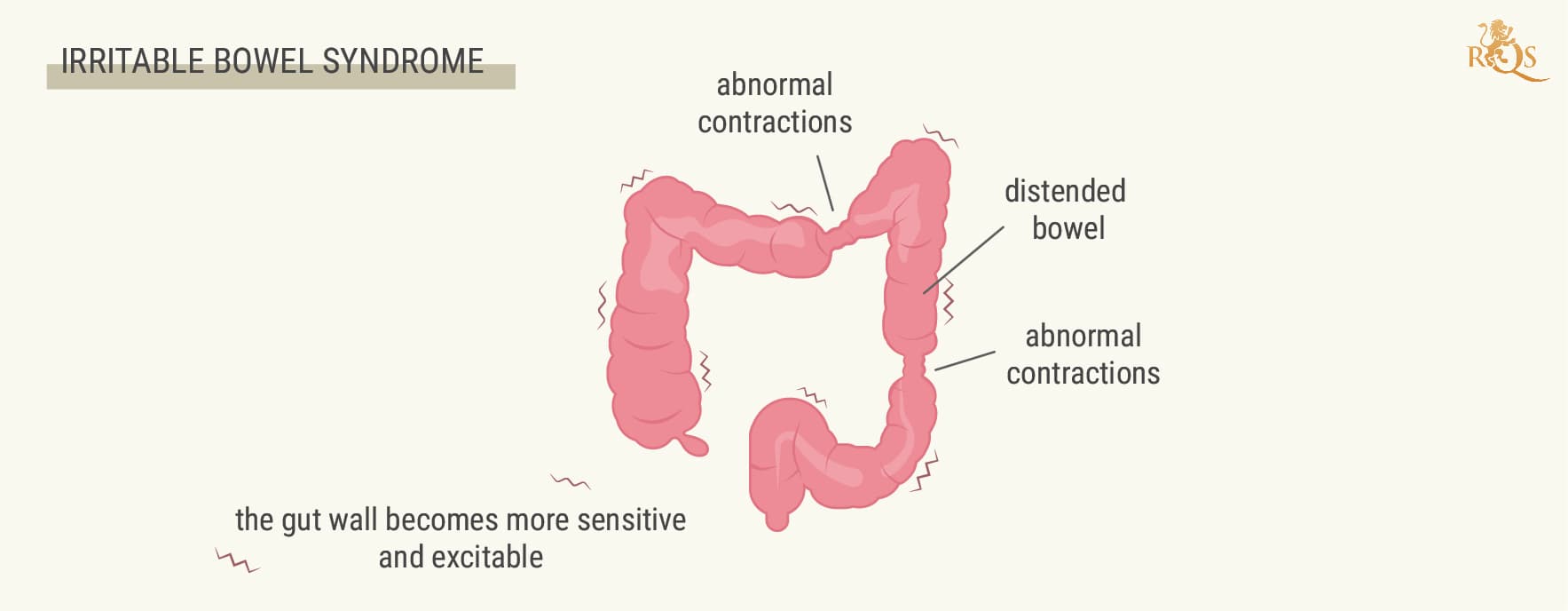 What Is IBS? What Is IBS?