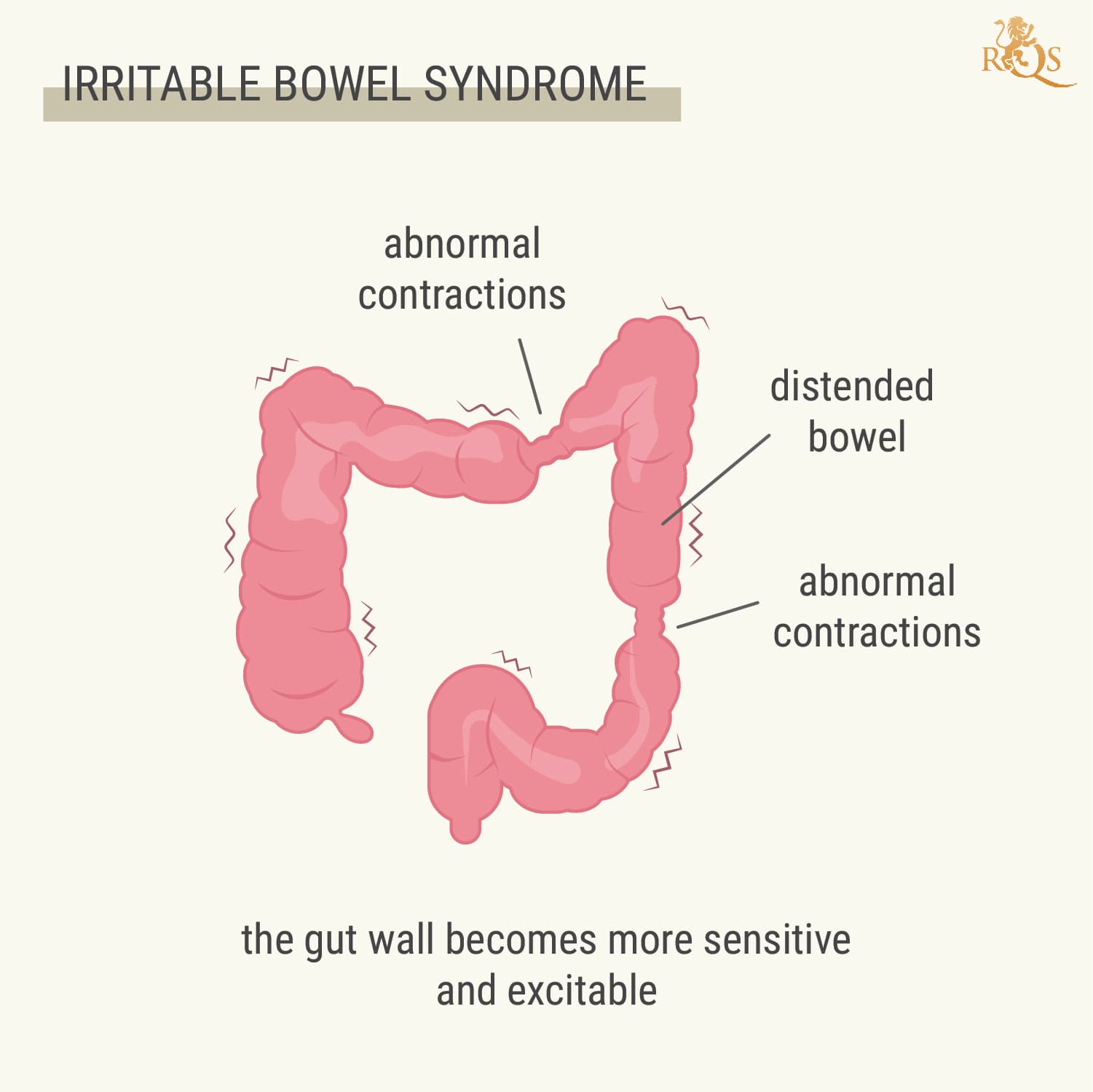 What Is IBS? What Is IBS?