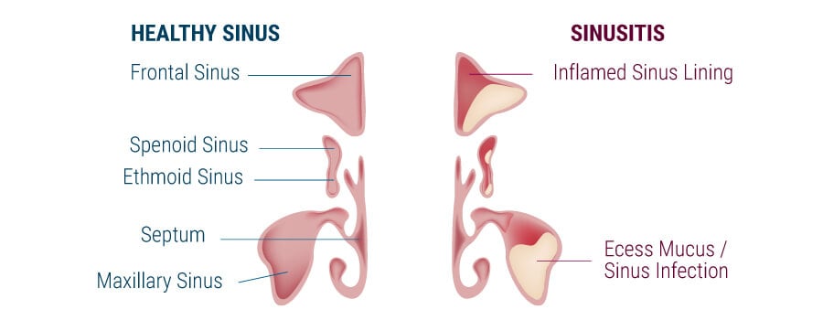 Sinus Inflammation