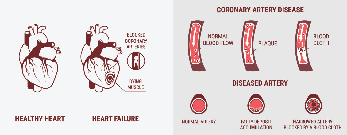 What Is Cardiovascular Disease (CVD)? What Is Cardiovascular Disease (CVD)?