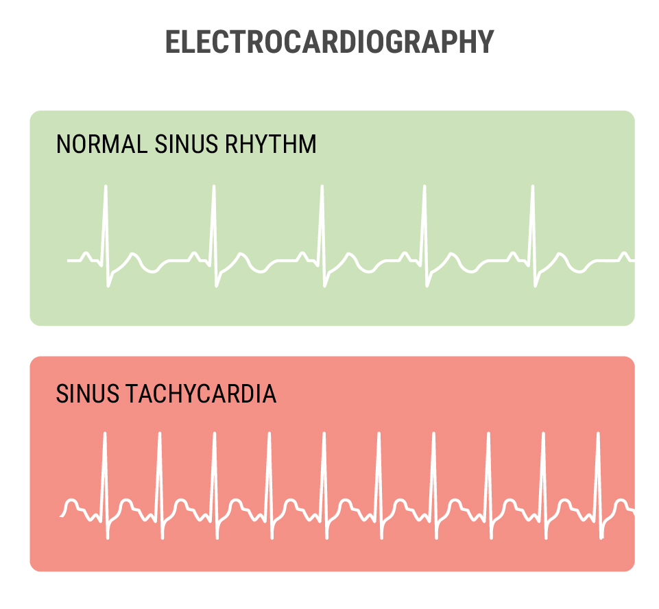 Why Does Cannabis Cause the Heart To Race?