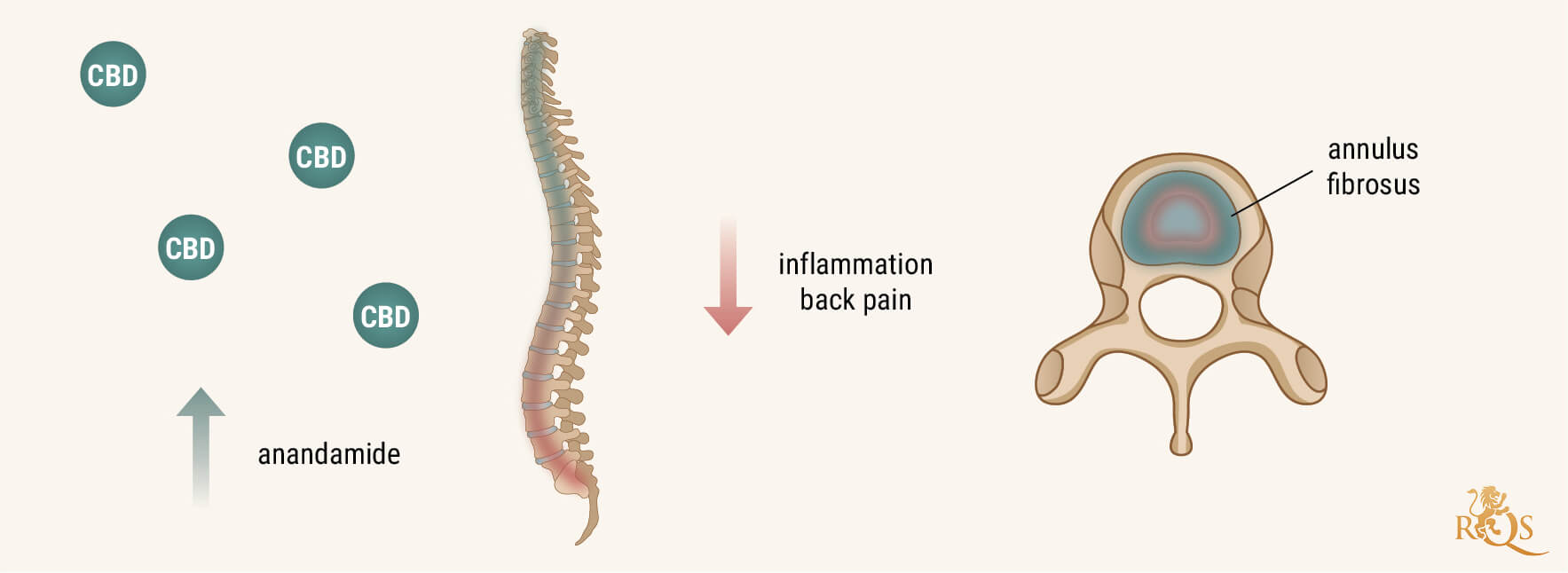 How Does CBD Help Degenerative Disc Disease?