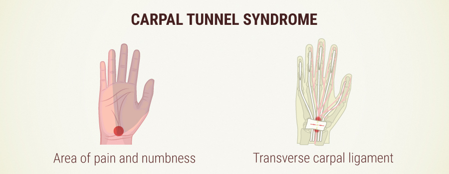 WHAT IS CARPAL TUNNEL SYNDROME?