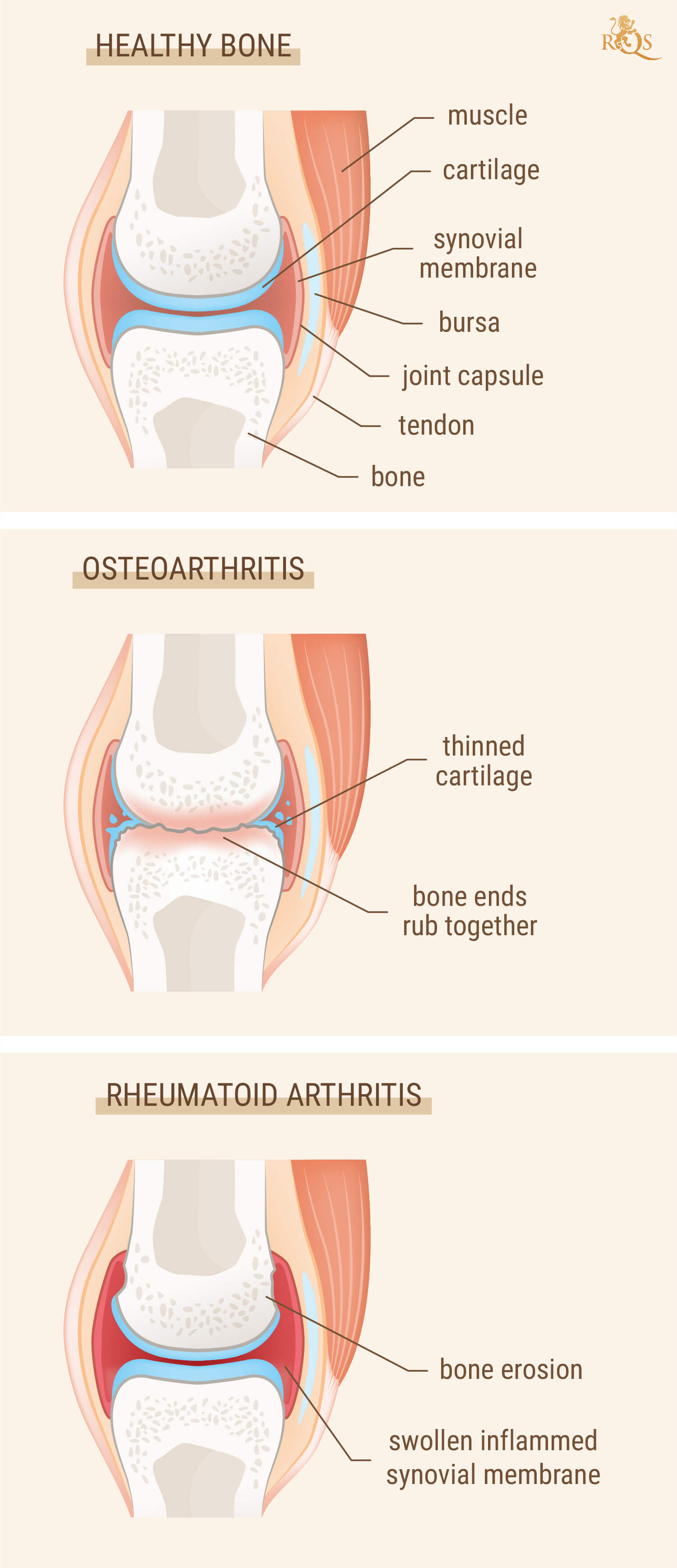 Are arthritis and rheumatism the same?