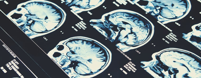 CBD and Epilepsy CBD and Epilepsy