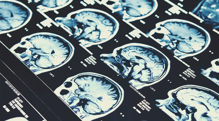 CBD and Epilepsy CBD and Epilepsy