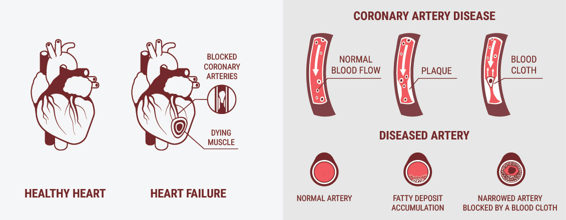 What Is Cardiovascular Disease (CVD)?