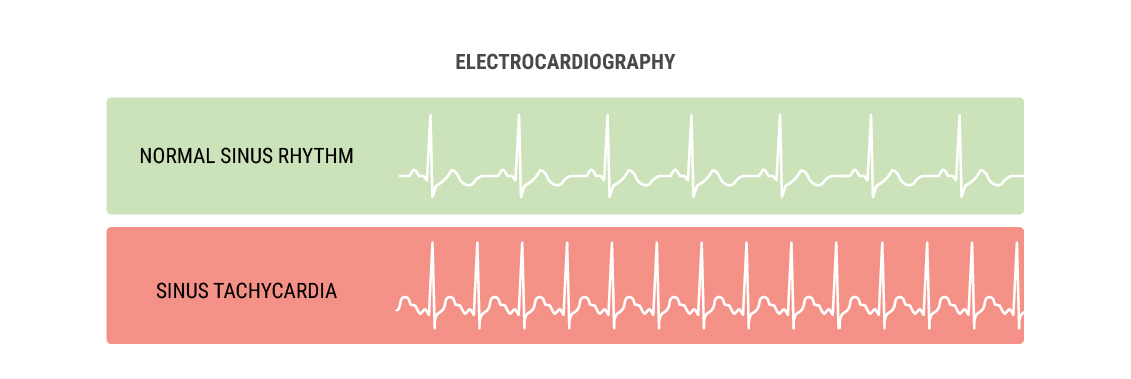 Why Does Cannabis Cause the Heart To Race?