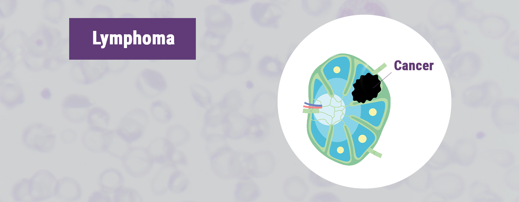 Ongoing Studies on Marijuana and Cancer Ongoing Studies on Marijuana and Cancer