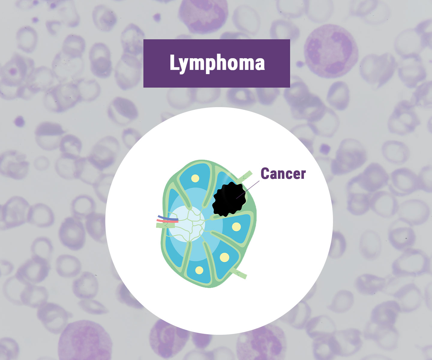 Ongoing Studies on Marijuana and Cancer