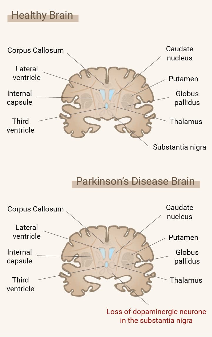 What Is Parkinson's Disease?