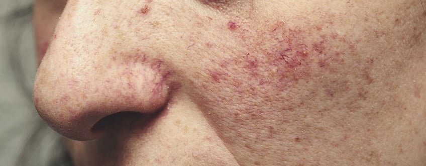 Rosacea Symptoms Rosacea Symptoms