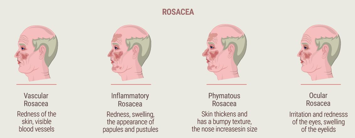 What Is Rosacea? What Is Rosacea?