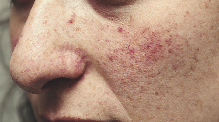 Rosacea Symptoms Rosacea Symptoms