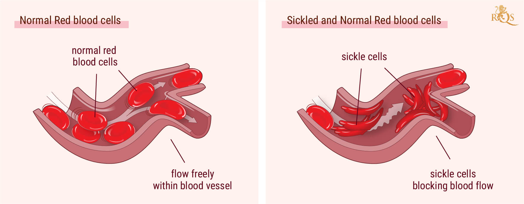 Cannabis and Sickle Cell Anemia Symptoms
