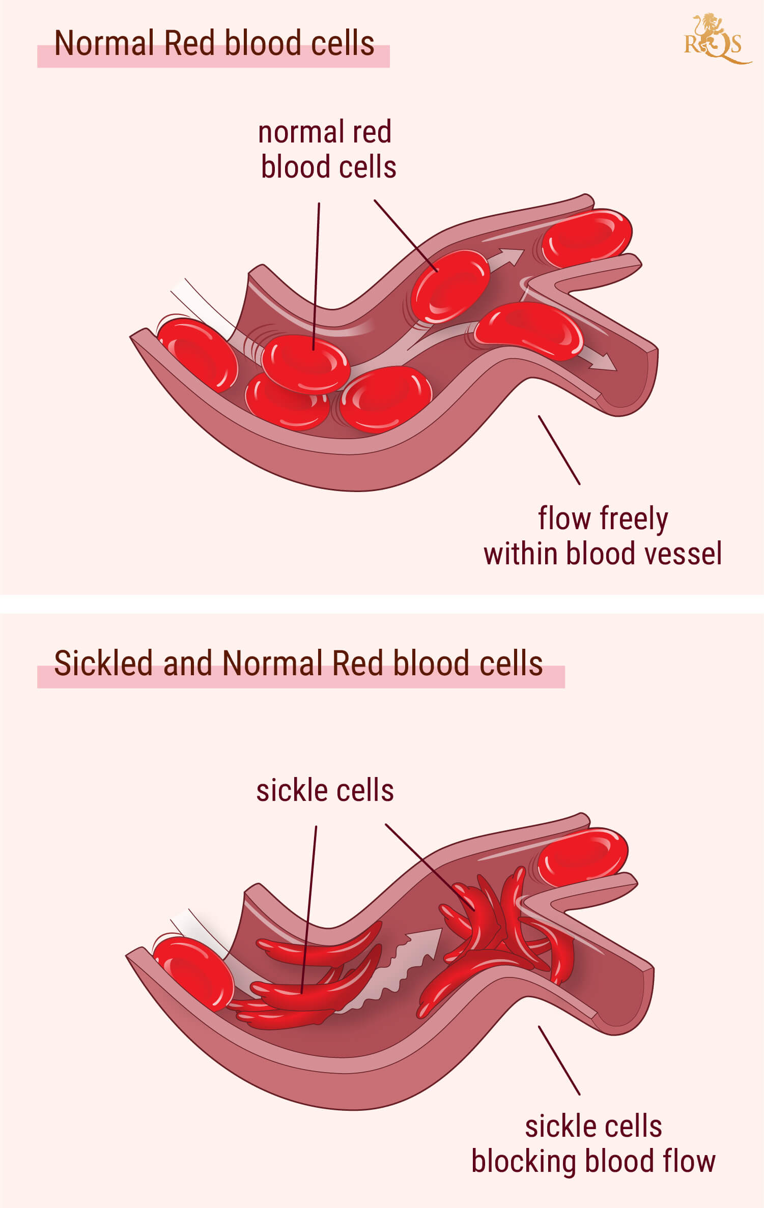 Cannabis and Sickle Cell Anemia Symptoms